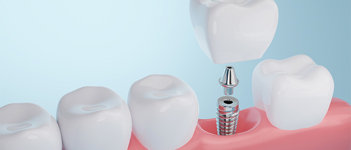 animated dental implants